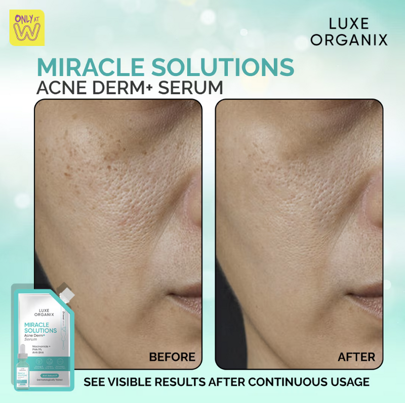 LUXE ORGANIX Miracle Solutions Acne Derm+ Serum Sachet 7ml